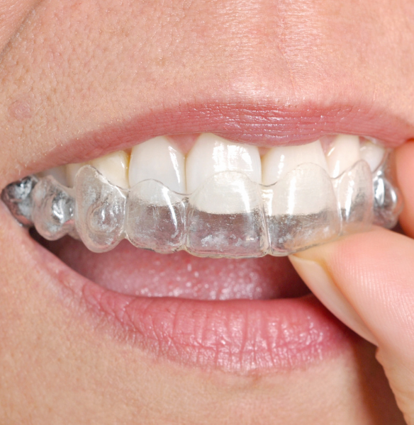 Invisible Braces for Adults
